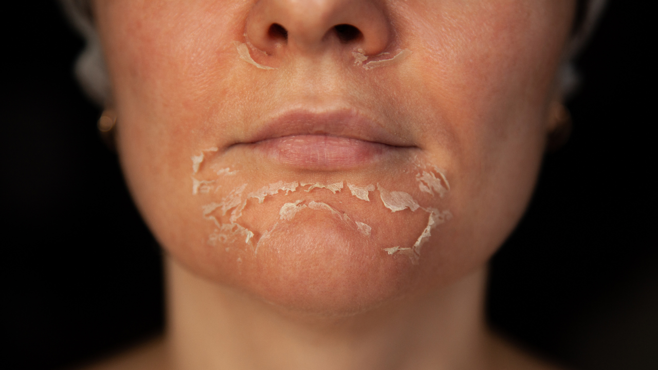 How to Treat Dry Skin: A Step-by-Step Guide