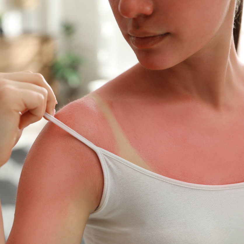 Can CBD Help Sun Damaged Skin?