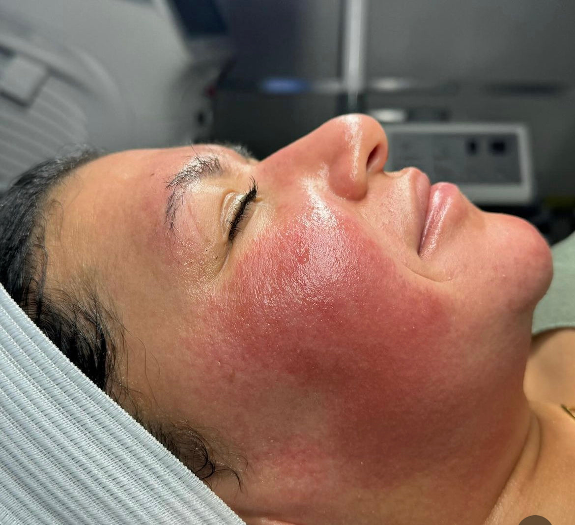 Rosacea Before and After