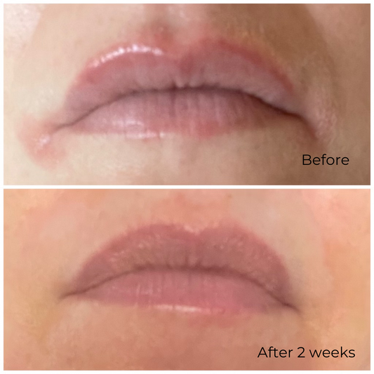 Lips Before and After Using Arctic Glow Tallow Balm | Deeply Hydrating Grass-Fed Tallow Balm for Dry, Chapped Lips | Nordic Skincare with Cloudberry & Lingonberry